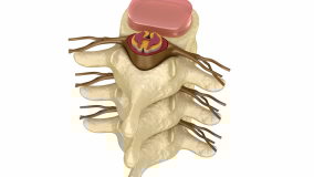 Prolapse of intervertebral disc